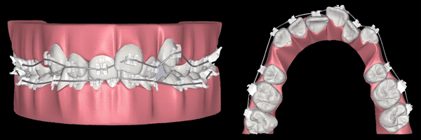Digital orthodontic treatment simulation showing planned tooth movement and bite alignment